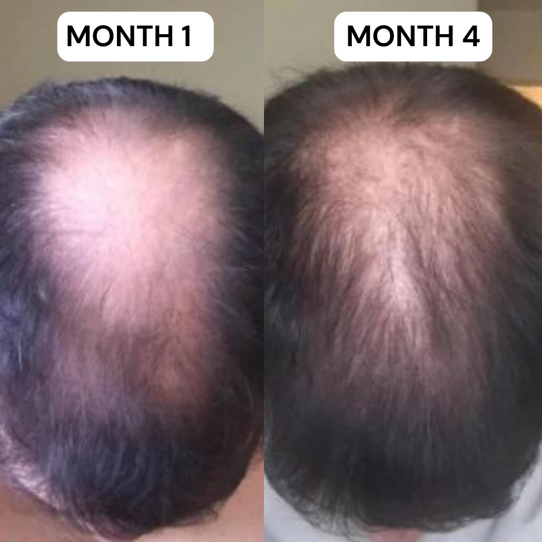 MAXORA VITAFOAM ™ Hair Growth Formula